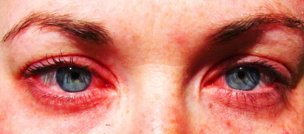 Allergy-01-600x265.jpg